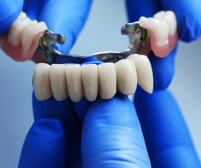 Dental Bridge